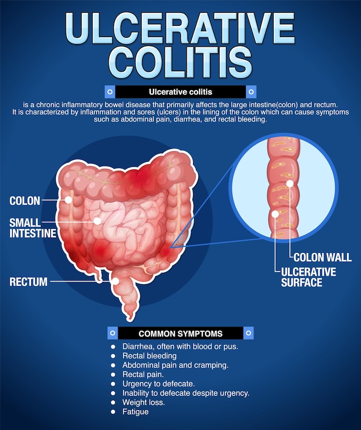 Vecteur gratuit infographie sur les symptômes de la colite ulcéreuse