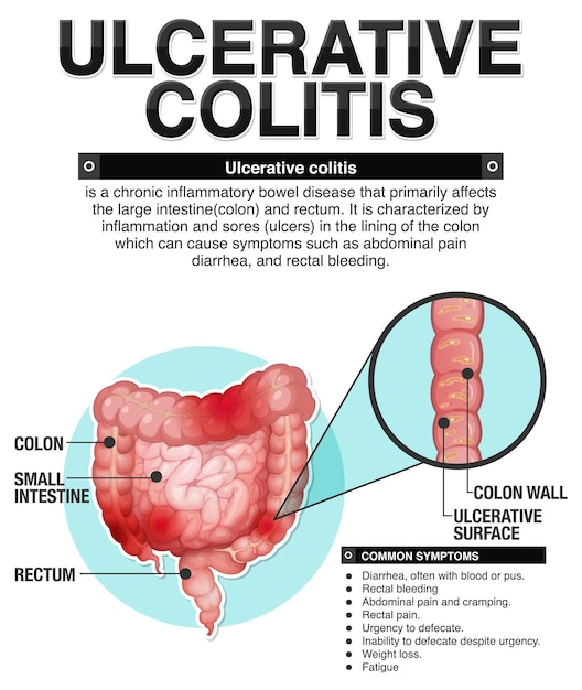 Vecteur gratuit infographie sur les symptômes de la colite ulcéreuse