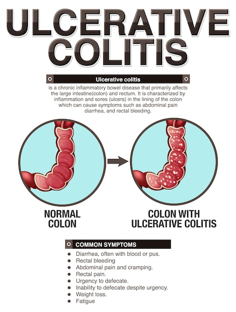 Infographie Sur Les Symptômes De La Colite Ulcéreuse