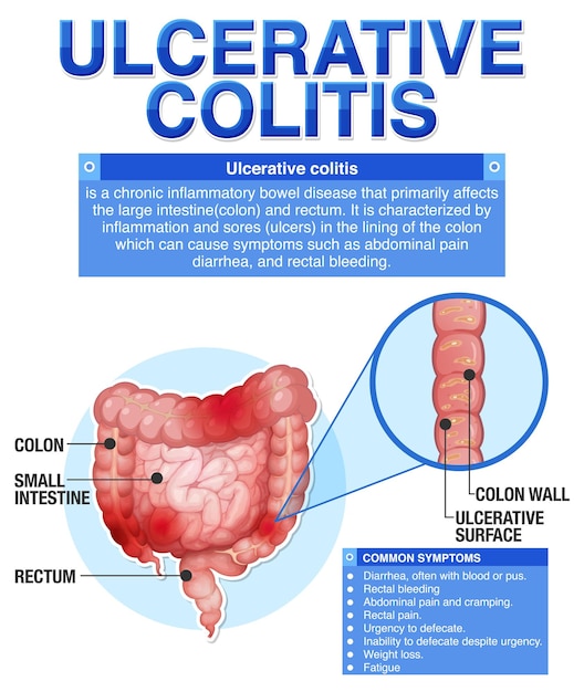 Vecteur gratuit infographie sur les symptômes de la colite ulcéreuse