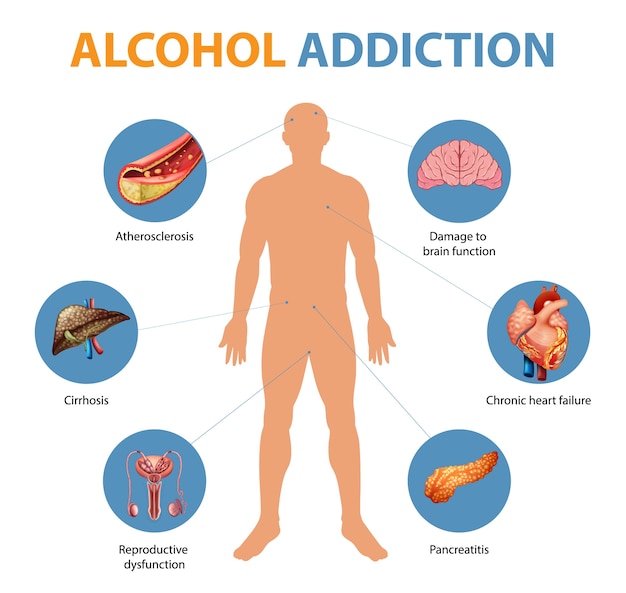 Vecteur gratuit infographie des symptômes de la dépendance à l & # 39; alcool