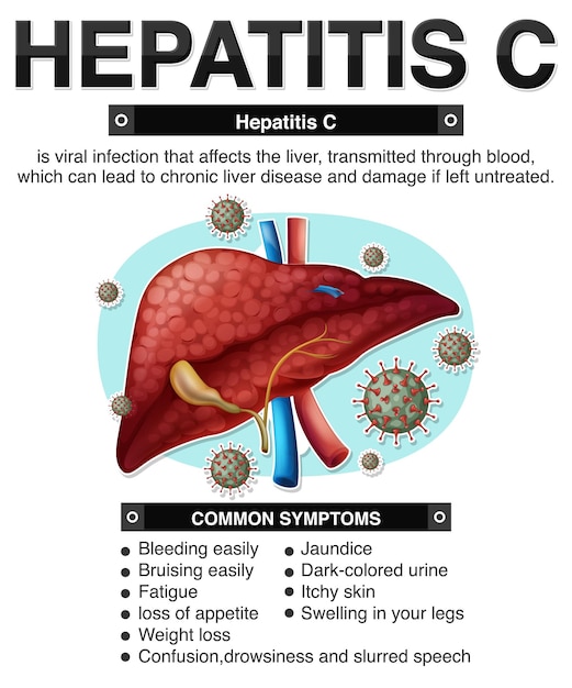 Vecteur gratuit infographie sur les symptômes de l'hépatite c