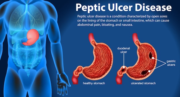 Infographie Sur L'ulcère Peptique