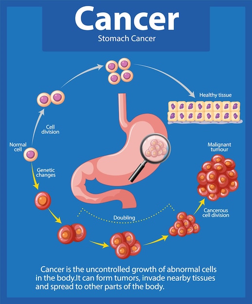 Vecteur gratuit infographique sur la croissance anormale des cellules du cancer de l'estomac