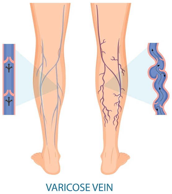 Jambes humaines avec varices