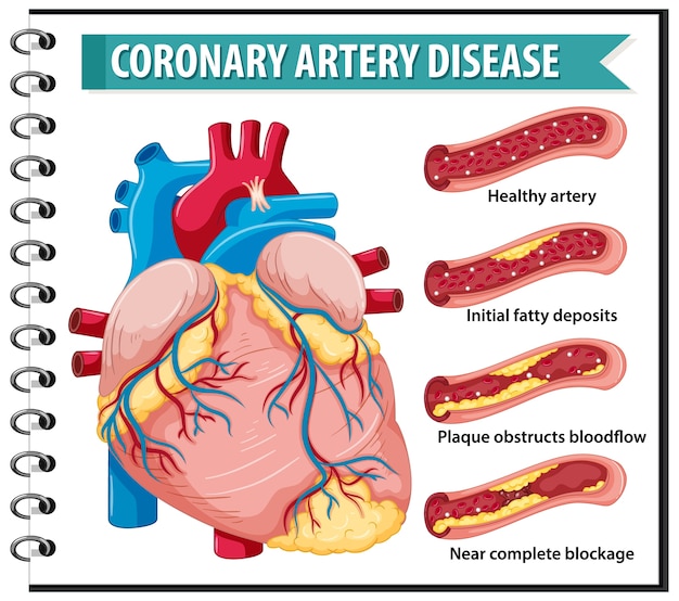 Maladie Coronarienne Pour L'éducation à La Santé Infographie