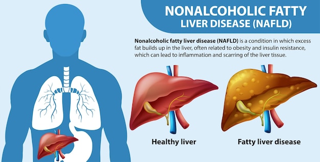 Vecteur gratuit maladie du foie gras non alcoolique nafld