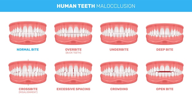 Vecteur gratuit malocclusion des dents infographie
