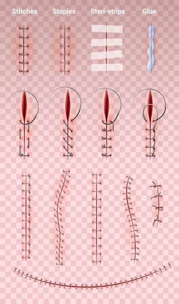 Points De Suture Chirurgicaux Ensemble Réaliste D'images Sur Transparent Avec Différentes Formes De Couture Médicale