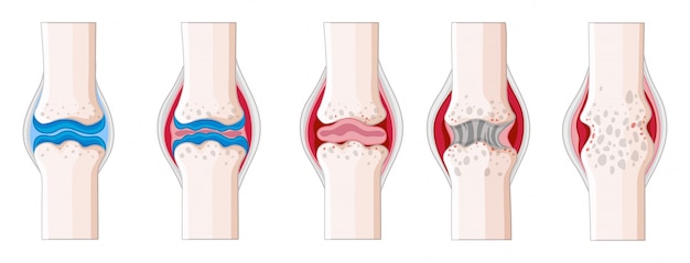 Vecteur gratuit la polyarthrite rhumatoïde dans l'illustration du corps humain