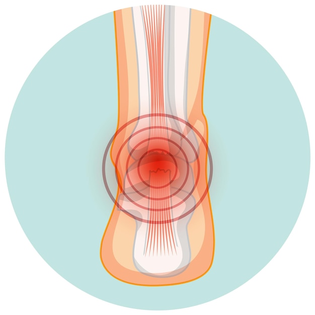 Vecteur gratuit rupture du tendon d'achille dans le modèle de cercle