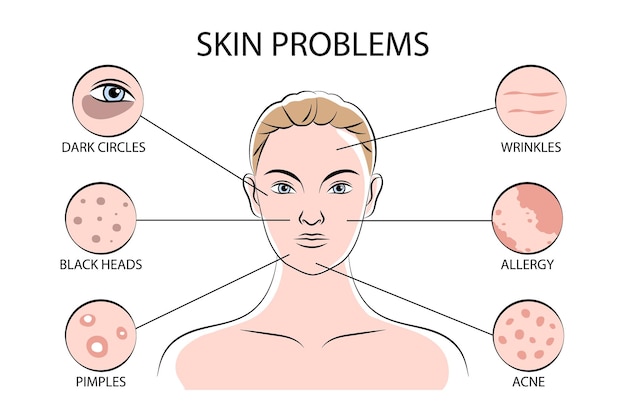 Schéma D'infographie Des Problèmes De Peau Avec Fixation Des Boutons Têtes Noires Rides Acné Allergie Cernes Zones Illustration Vectorielle Plane