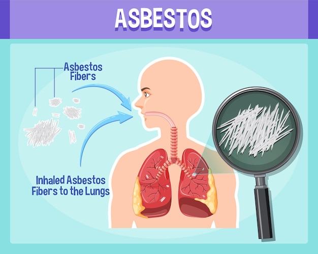 Vecteur gratuit schéma montrant l'asbestose dans les poumons