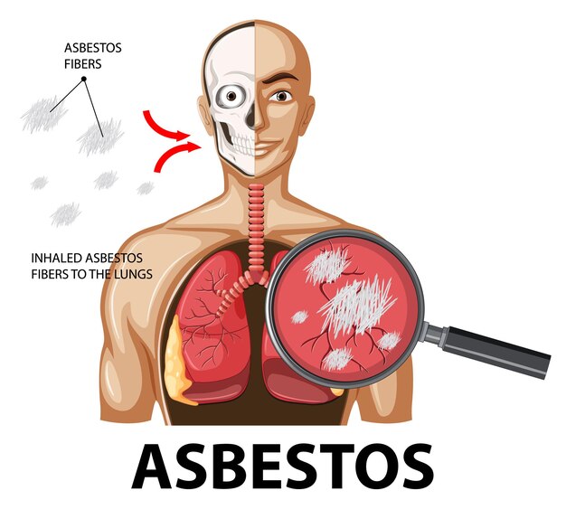 Schéma montrant l'asbestose dans les poumons