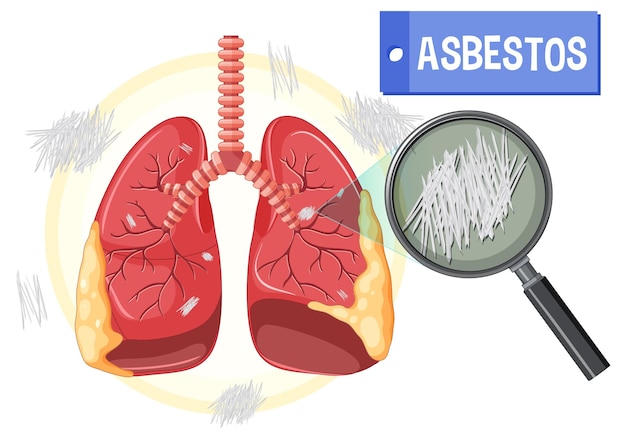 Vecteur gratuit schéma montrant l'asbestose dans les poumons