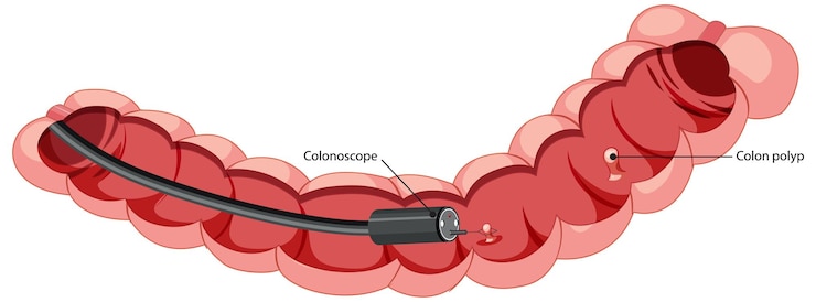 Vecteur gratuit schéma montrant l'intérieur du côlon avec coloscope