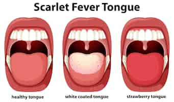 Vecteur gratuit symptômes de la langue de la scarlatine