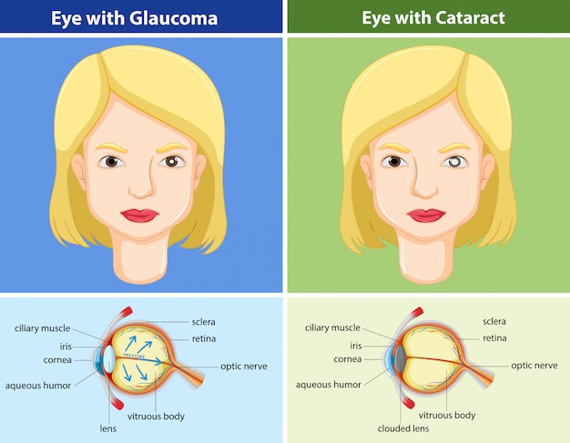 Vecteur gratuit tableau de comparaison des yeux avec et sans glaucome