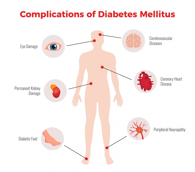 Vecteur gratuit tableau éducatif médical sur les complications du diabète avec les organes humains affectés