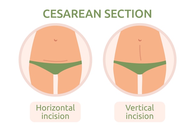 Type d'incisions de césarienne dessinées à la main