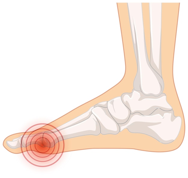 Vecteur gratuit types d'hallux valgus sur fond blanc