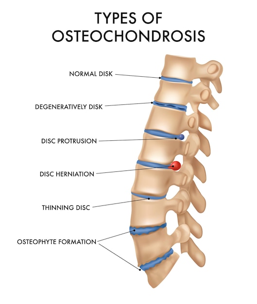 Types d'ostéochondrose avec colonne vertébrale