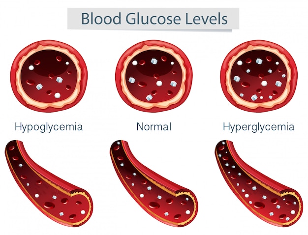 Vecteur 3 différents niveaux de glucose sanguin