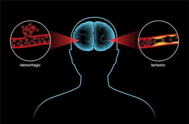 Accident vasculaire cérébral ischémique et hémorragique