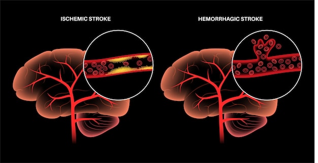 Accident Vasculaire Cérébral Ischémique Et Hémorragique