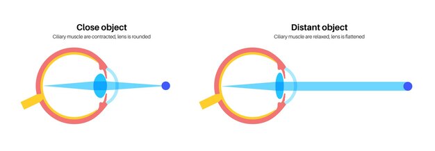 Vecteur affiche d'accommodation oculaire
