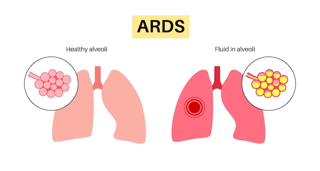 Vecteur affiche anatomique ards