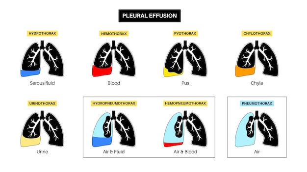 Vecteur affiche d'épanchement pleural