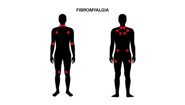 Vecteur affiche médicale sur la fibromyalgie