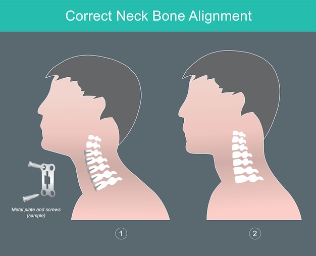 Vecteur alignement correct de l'os du cou montrer en vue latérale humaine l'alignement correct de l'os du couxa