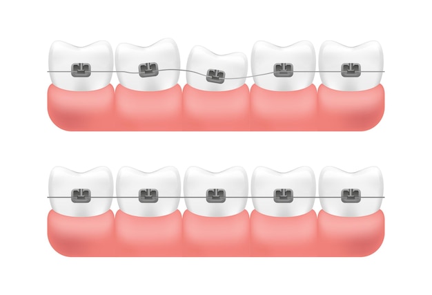 Alignement des dents avec le système d'accolades.