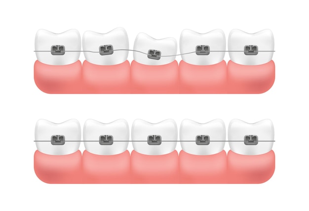 Vecteur alignement des dents avec le système d'accolades.