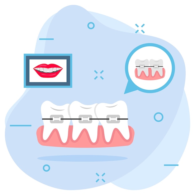 Aligners dentaires ou appareils orthodontiques métalliques avec concept de sourire avant et après Traitement orthodontique lingual