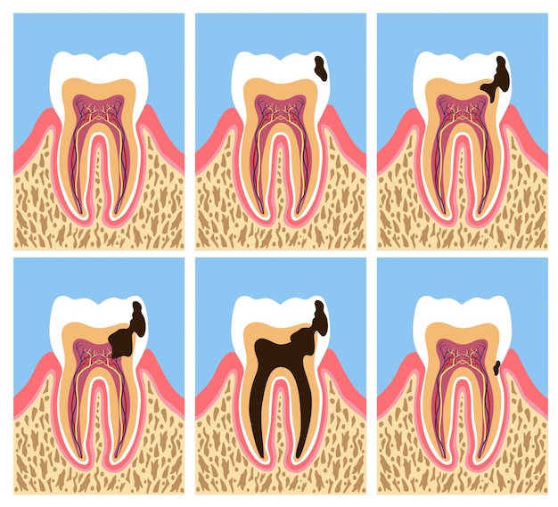 Vecteur anatomie dentaire avec phases de carie dentaire