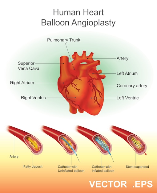 Vecteur angioplastie de ballon de coeur humain