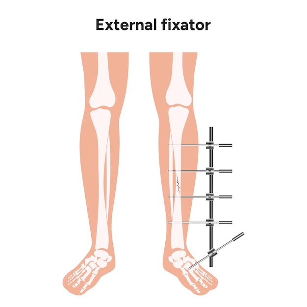 Vecteur appareil de fixation externe à lizarov