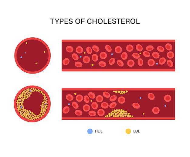 Vecteur artère sanguine de cholestérol
