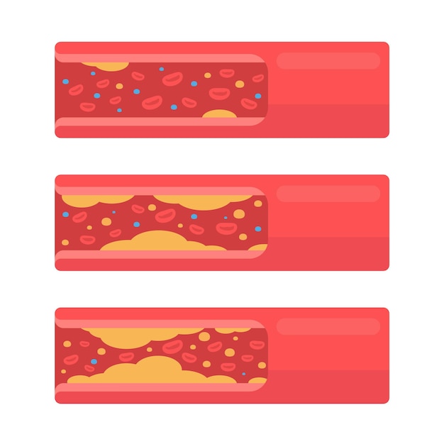 Artères Coronaires Avec Accumulation De Graisse Dans Le Corps