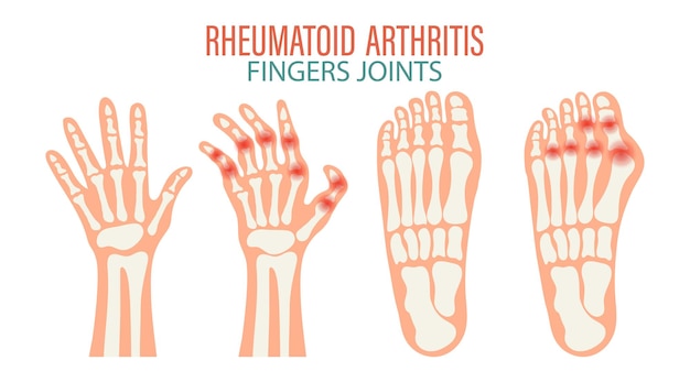 Arthrite Rhumatoïde Arthrose Des Articulations Des Doigts Et Des Orteils Concept Médical