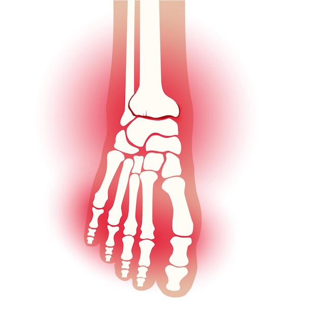 Vecteur articulation du pied d'arthrite. douleur rhumatoïde dans la jambe plate illustration vectorielle