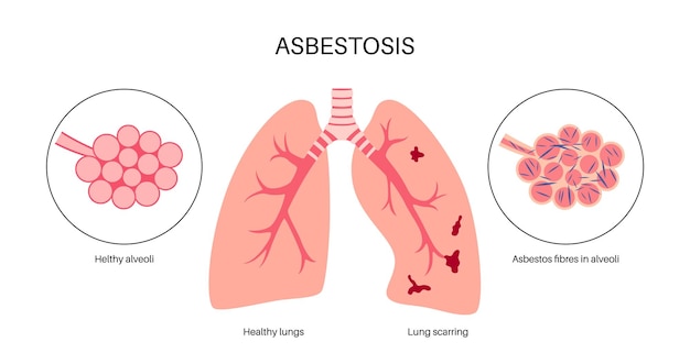 Asbestose Pulmonaire