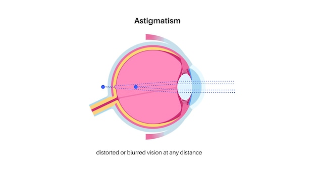 Vecteur astigmatisme maladie de l'œil