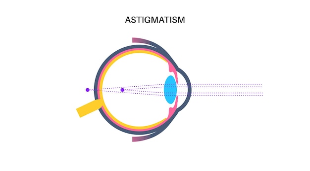 Vecteur astigmatisme maladie de l'œil