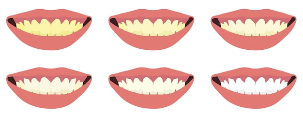 Vecteur avant et après le traitement de blanchiment des dents de blanc à jaune dans l'illustration 3d