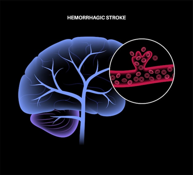 AVC hémorragique cérébral