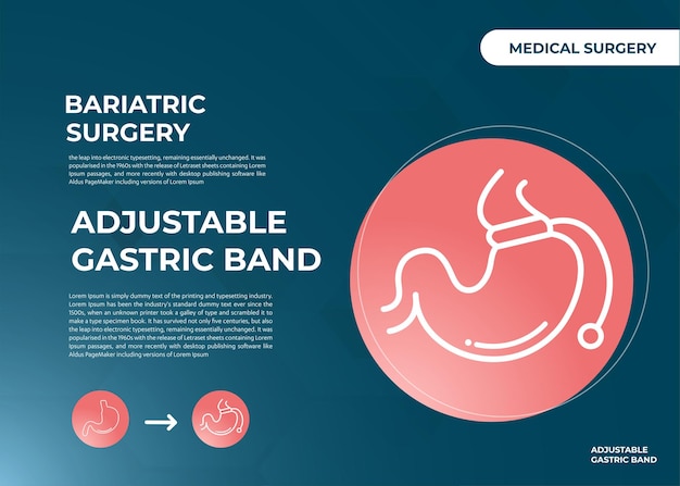 Vecteur bande gastrique réglable concevoir vecteur de chirurgie de perte de poids illustration